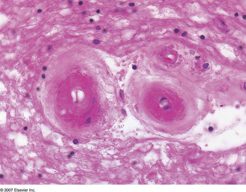 CADASIL Photo by cat_at_uw | Photobucket